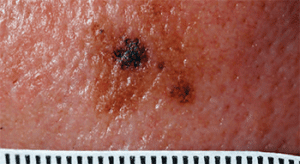 mitigating-melanoma-lentigo-maligna