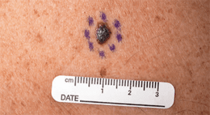 mitigating-melanoma-nodular