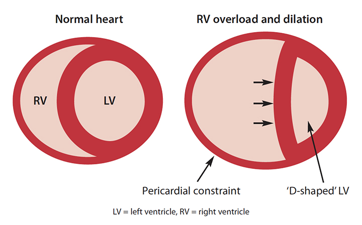 right-sided-heart-failure-ventricular-interdependence