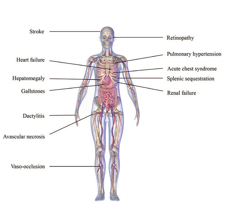 sickle-cell-disease-effects