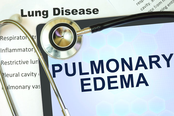 pulmonary edema