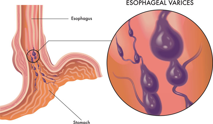 esophageal