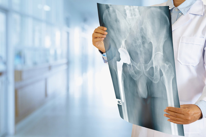 Osteoporosis awareness: Be the patient’s advocate