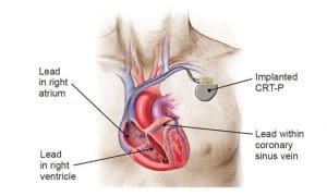Biventricular pacemakers