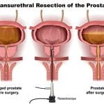 TURP