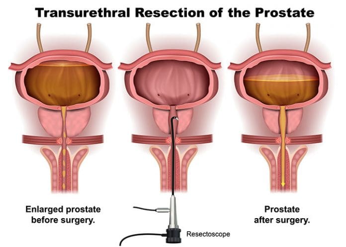 Prostate Procedures TURP: when do we perform surgery and potential complications