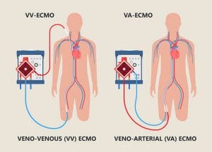 Types-of-ECMO