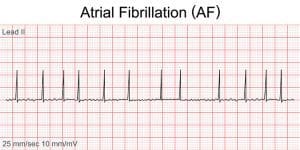 Atrial fibrillation