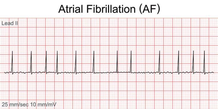 Atrial fibrillation: recognition and management for quality of life
