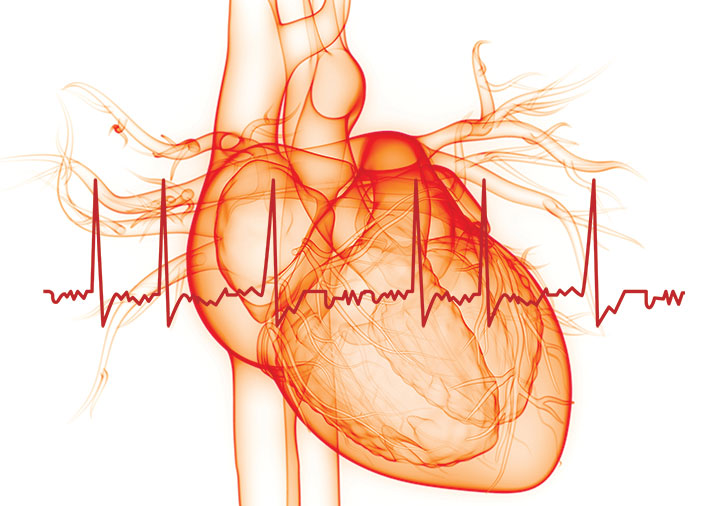 Atrial fibrillation