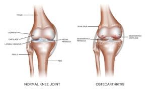 Normal vs. osteoarthritic knee joint