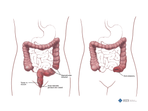 Colostomy