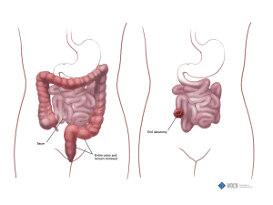 Ileostomy