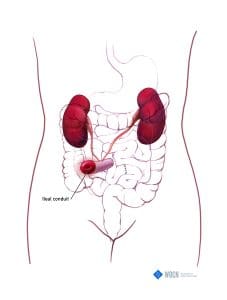 Ileal conduit (urostomy)