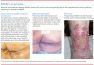 Masd Rash Moisture-associated skin damage: The basics