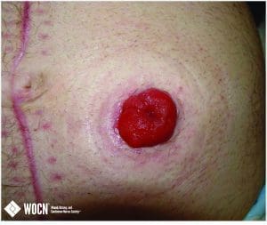 Healthy stoma