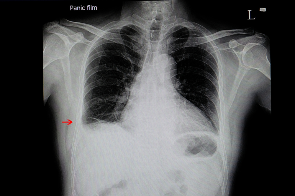 Hemothorax X Ray Dissecting Thoracic Aortic Aneurysm With Left Sided Hemothorax X Ray Dissecting Thoracic Aortic Aneurysm With Left Sided