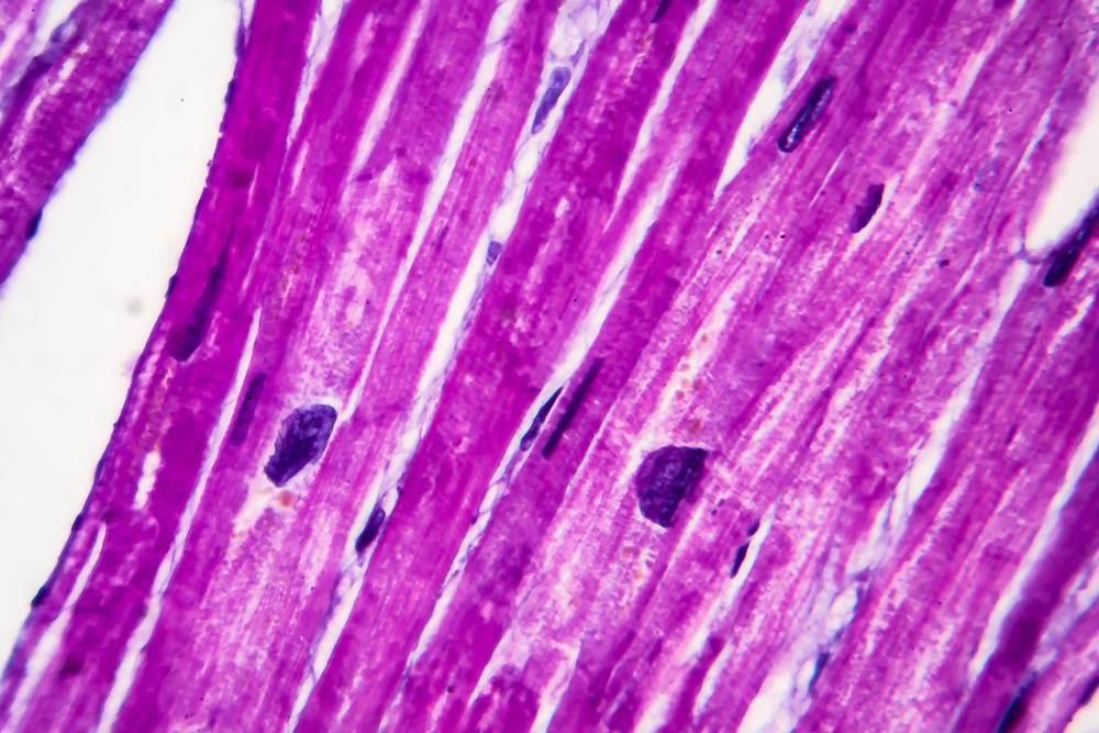 Hypertrophic Cardiomyopathy