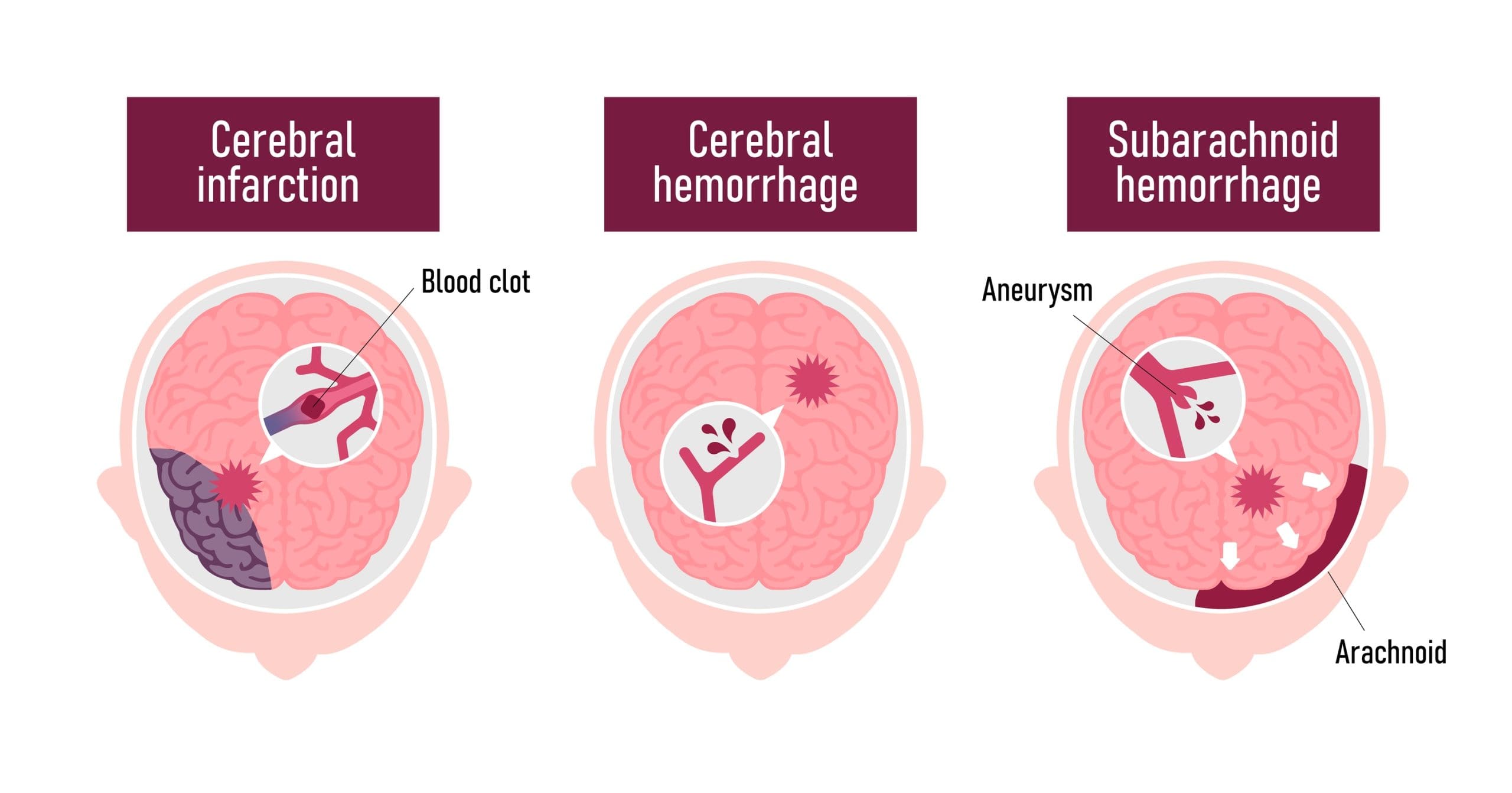 What is a Subarachnoid Hemorrhage (SAH)?