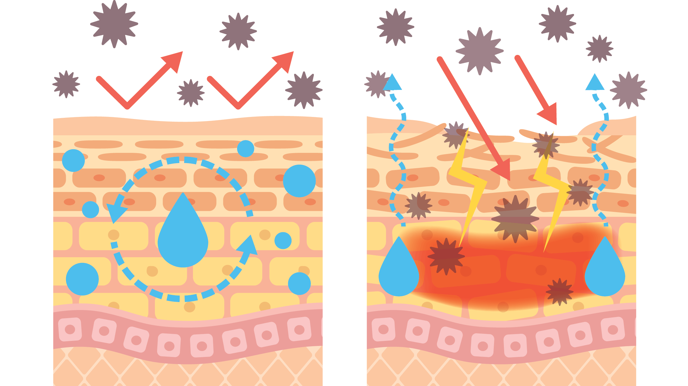 Living with atopic dermatitis