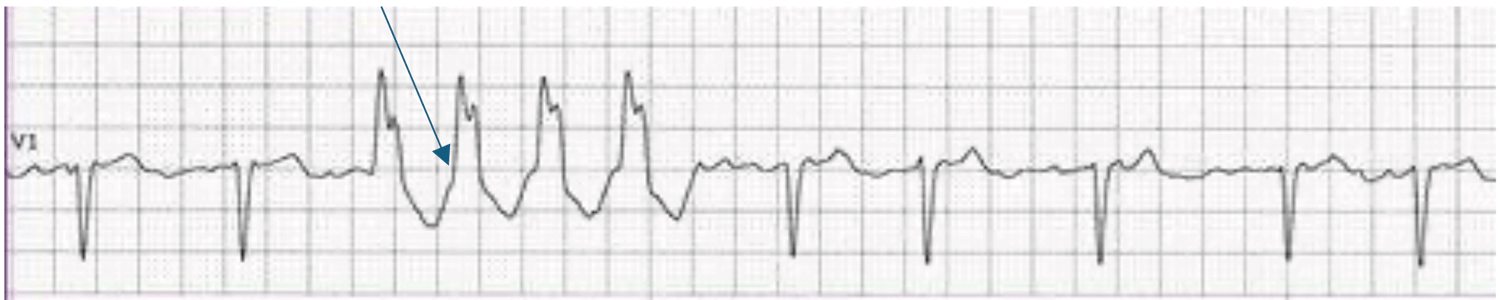 Non-sustained-ventricular-tachycardia