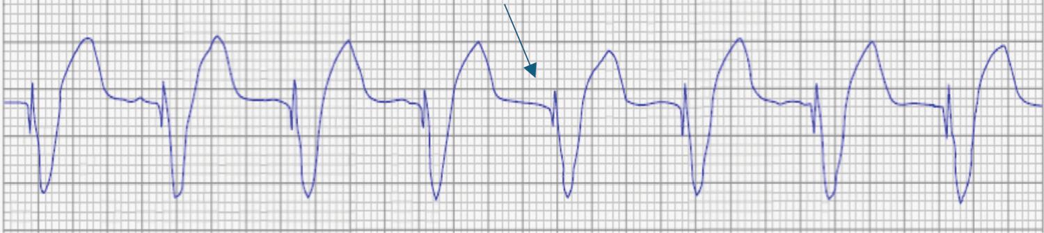 Ventricular-paced-beat-with-a-spike-no-PVC