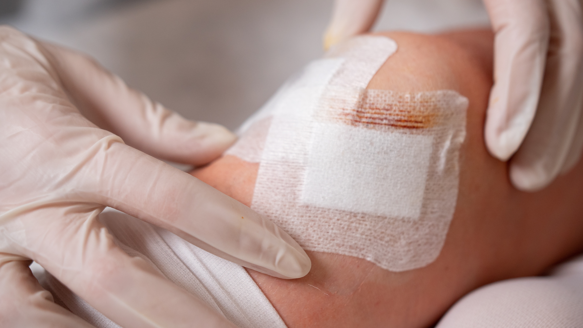 Dress for success: Wound dressing basics Dress for success: Wound dressing basics